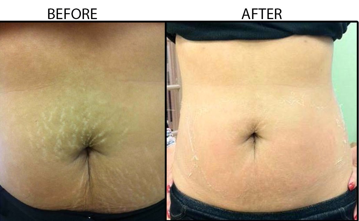 Алмазная микродермабразия