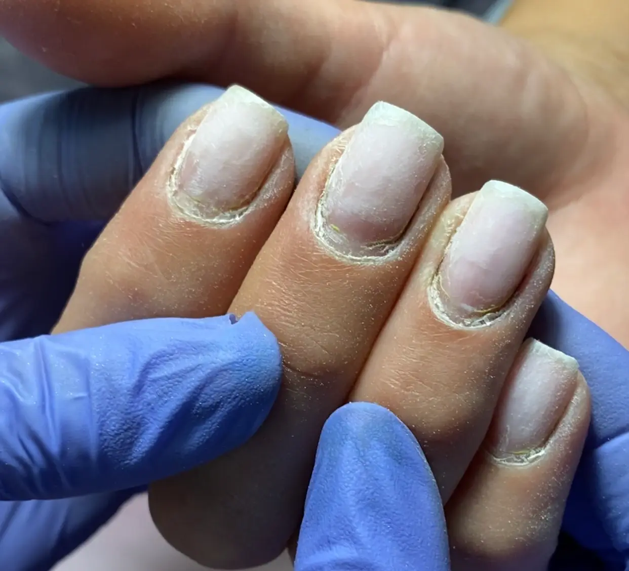 Повреждённая ногтевая пластина и залипшая кутикула после некачественного маникюра, с пропилами и сухими участками.