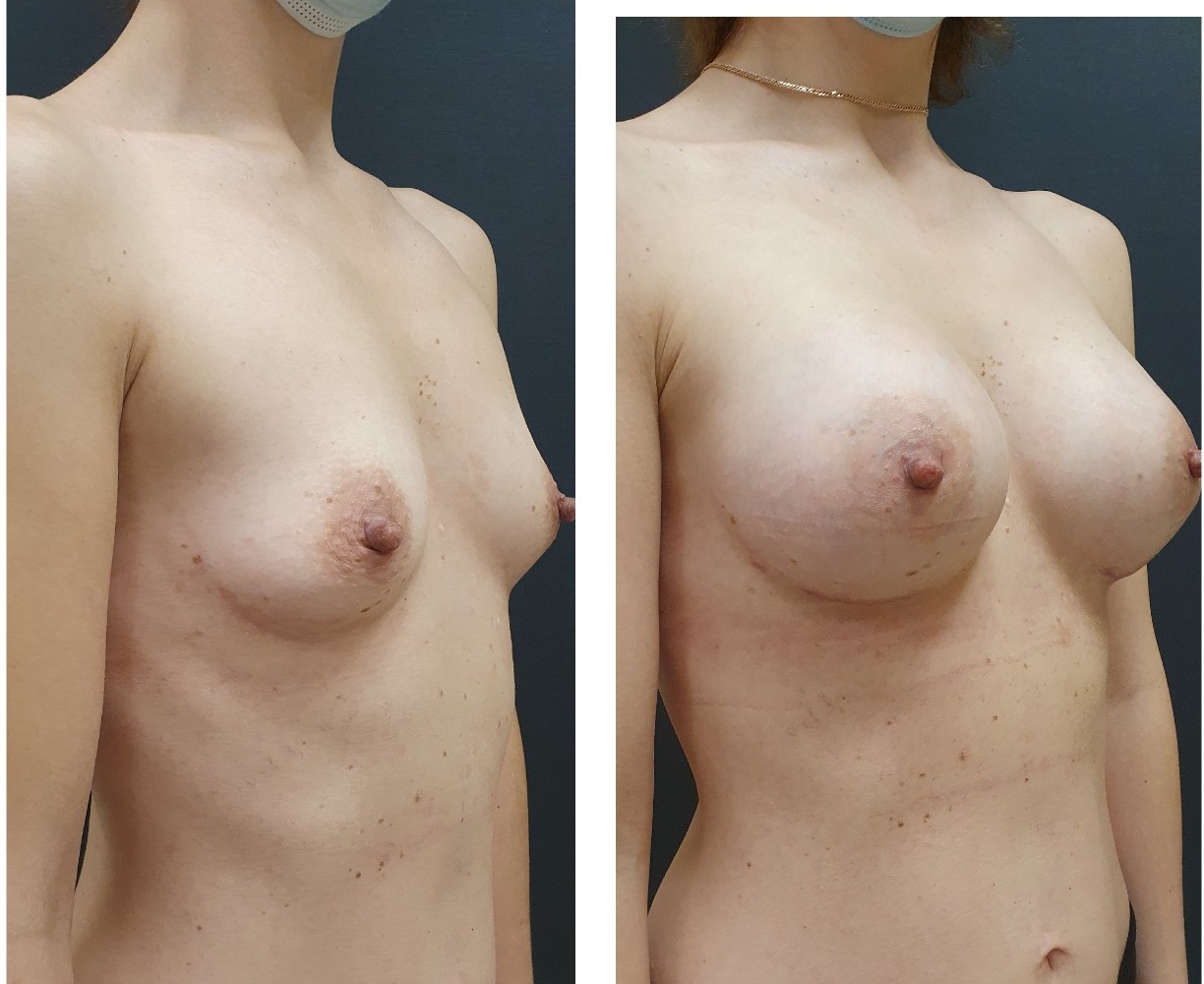 как делают пластическую операцию груди женщин (120) фото