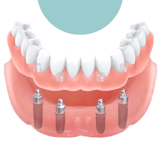 имплантация челюсти на 6 имплантах. протезирование в королеве. протезирование в королеве. льготные зубные протезы пенсионерам. двухэтапная имплантация зубов.