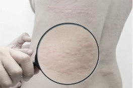 Аппараты холодной плазмы. PLASMA LINER ACADEMY