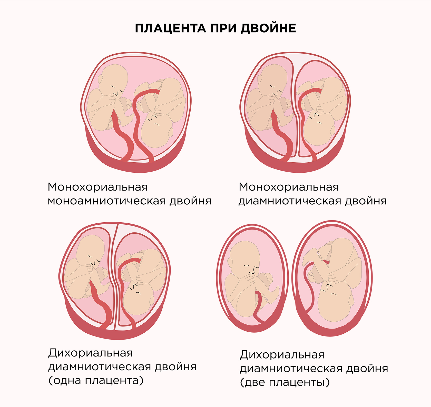 Инфаркт плаценты при беременности — опасно ли это?