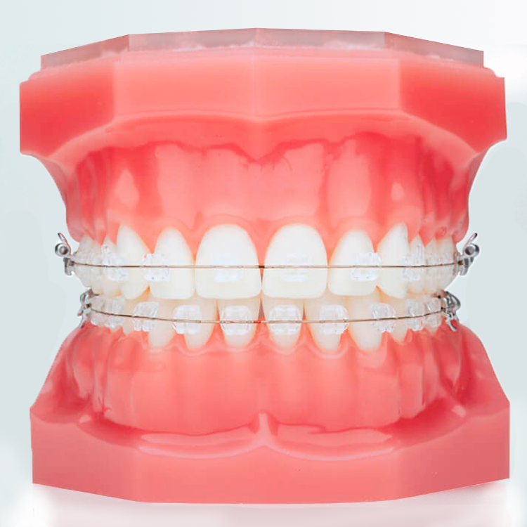 Установка лигатурных брекетов в Дербенте. Брекеты H4