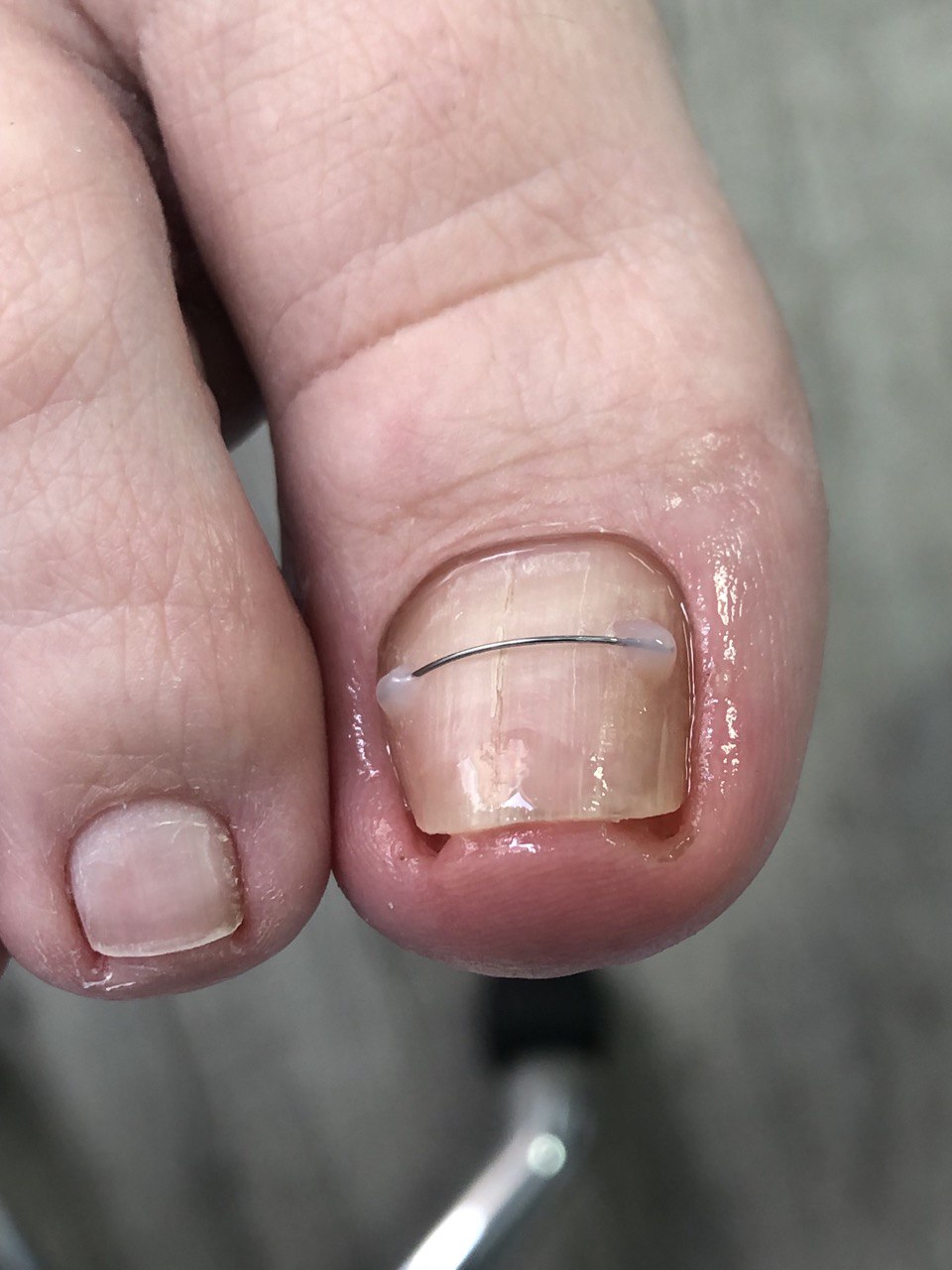 вросший ноготь на ноге, вросший ноготь, удаление вросшего ногтя, вросший ноготь лечение, вросший ноготь операция, удалить вросший ноготь, вросший ноготь цена