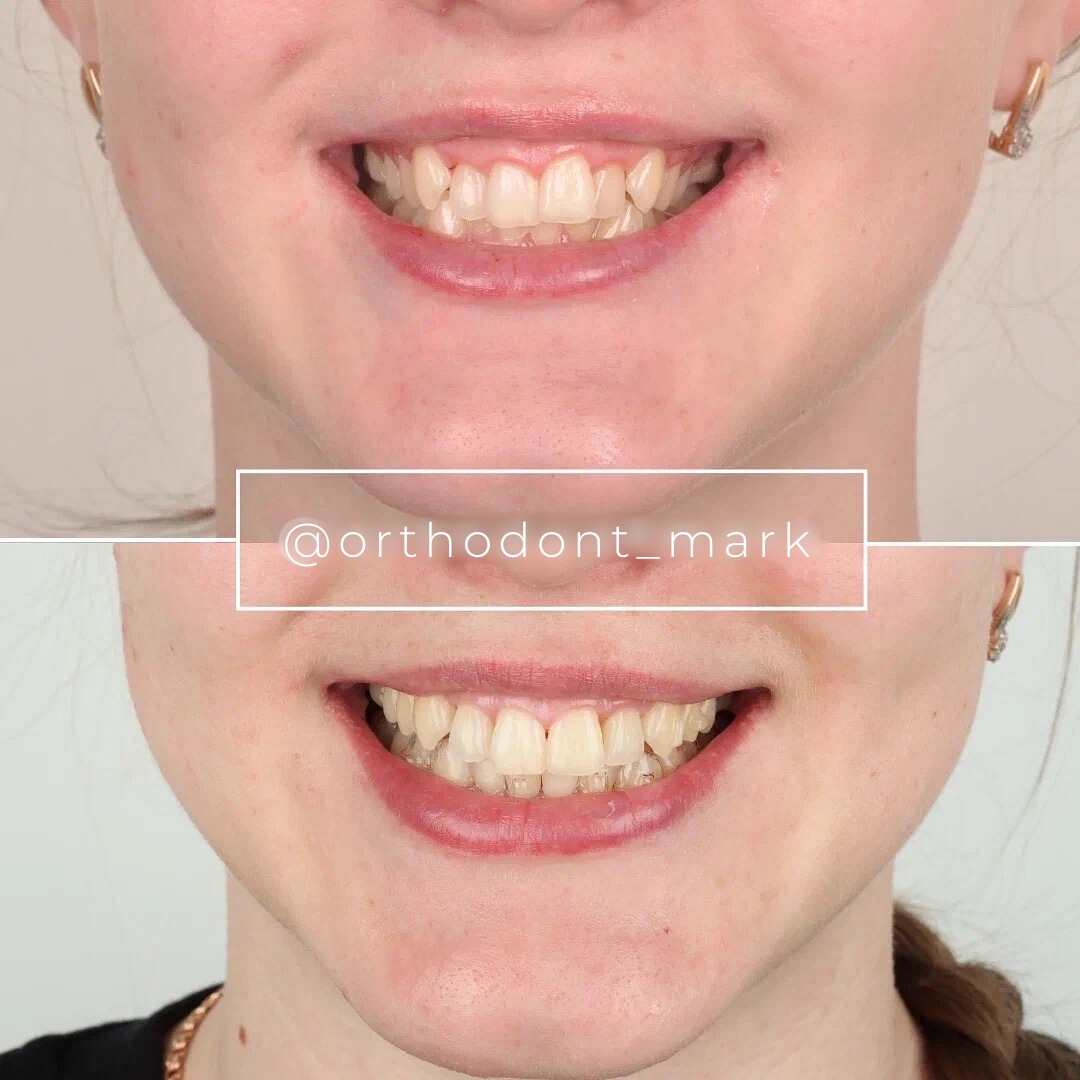Correcting Narrow Arches and Inward Lateral Incisors