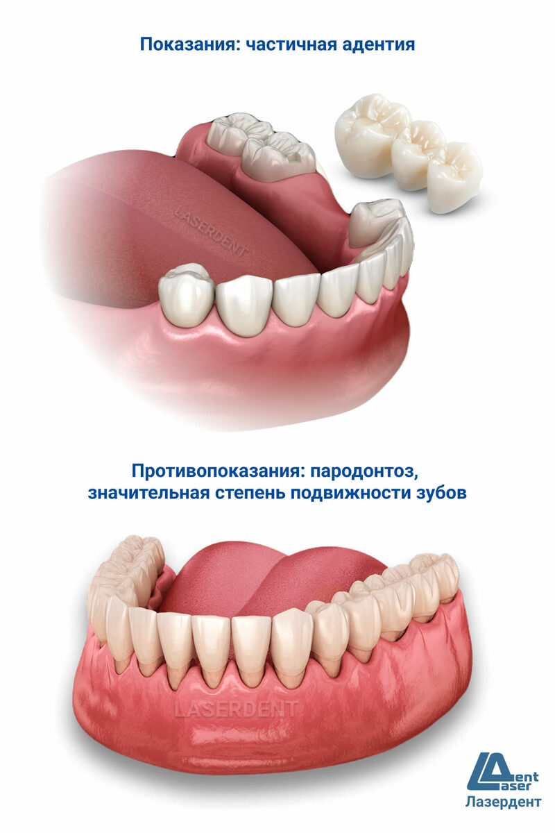 Комплексная имплантация нескольких зубов подряд