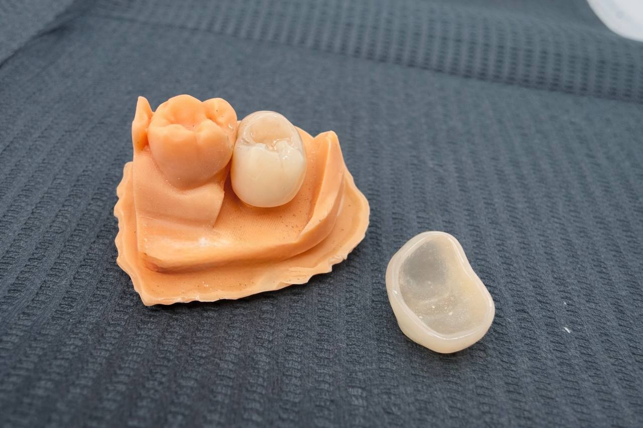 Временная коронка из ПММА