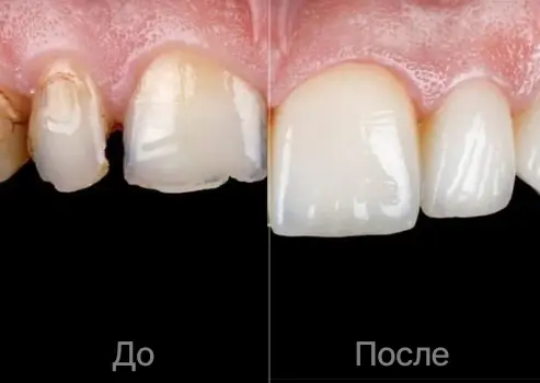 Восстановление зубов