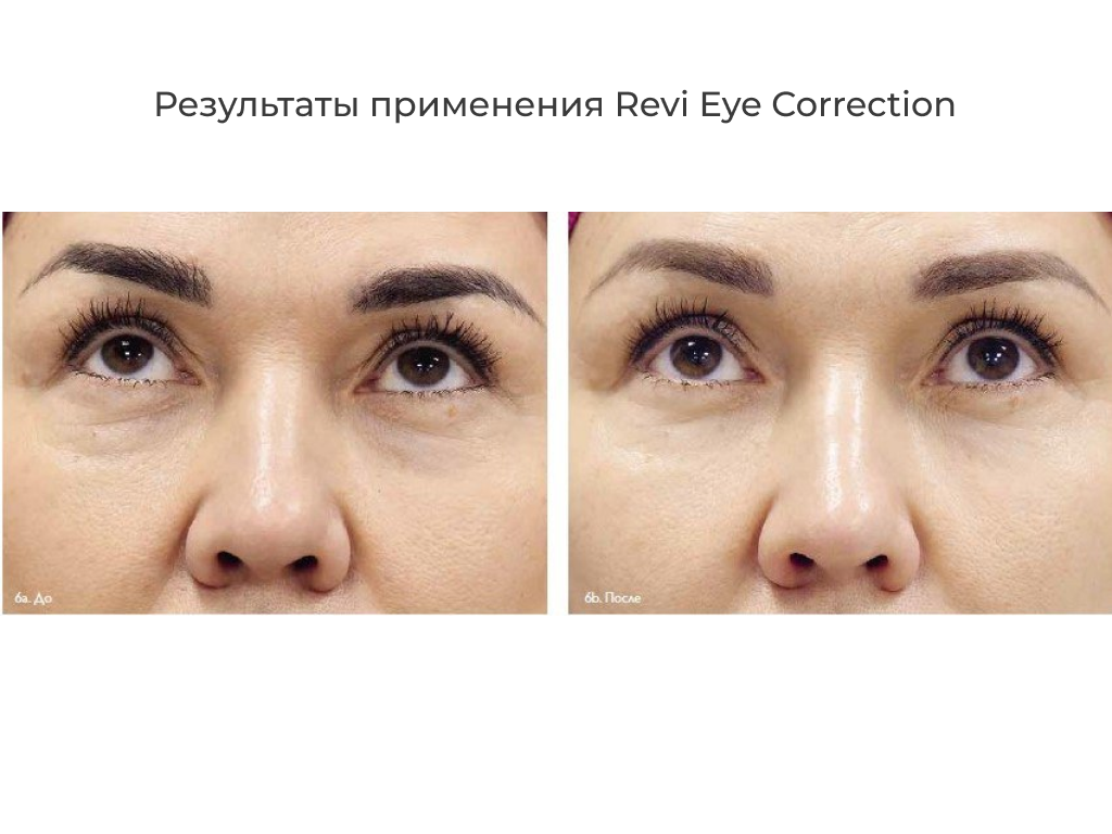 Биоревитализация revi eye