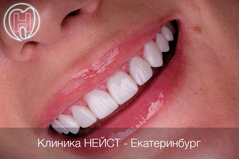 Премиальные композитные виниры в Екатеринбурге, цвет Блич 3