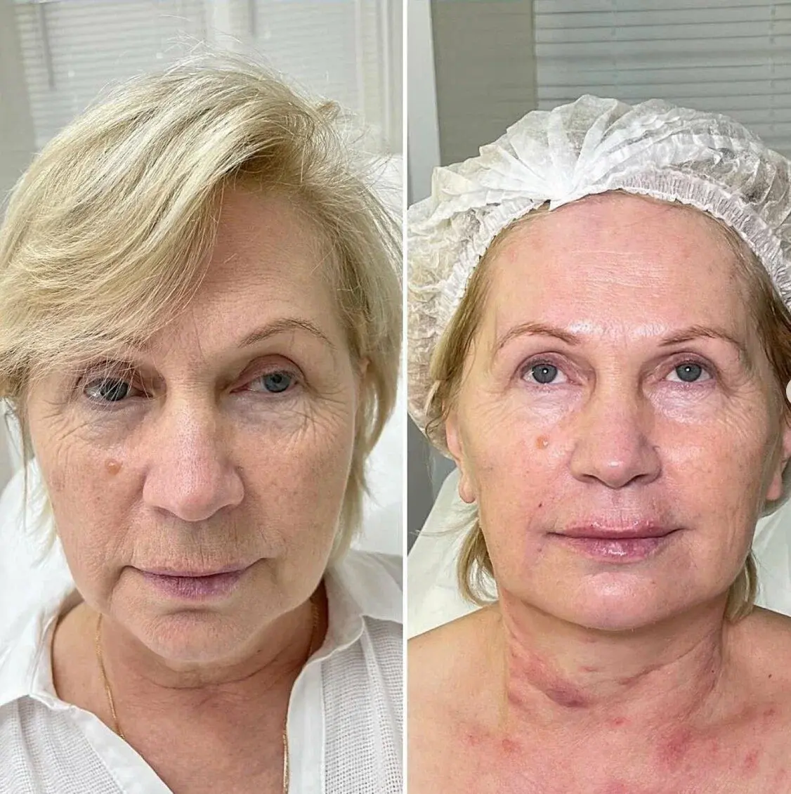 Результат до и после процедуры Ultraformer MPT, пациентка клиники Carla Medici