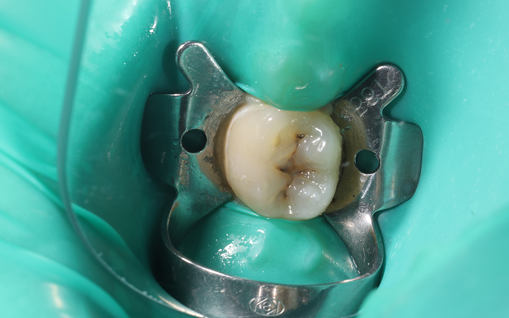 Реставрация зуба композитным материалом Harmonize A3