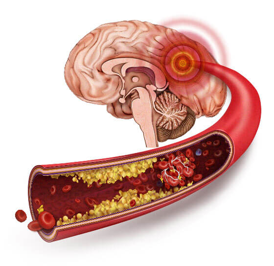 Лечение сосудистой деменции в Харькове — Врач-невролог Ксения Песоцкая