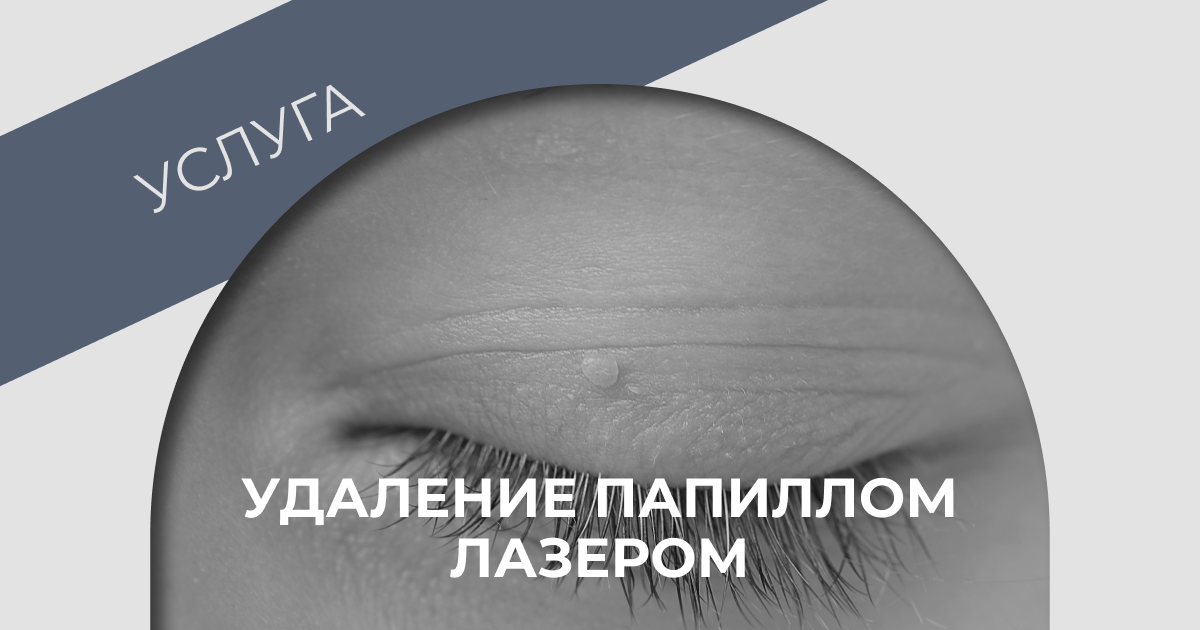 Лазерное удаление папиллом аппаратом DEKA PUNTO в Казани | Клиника ...