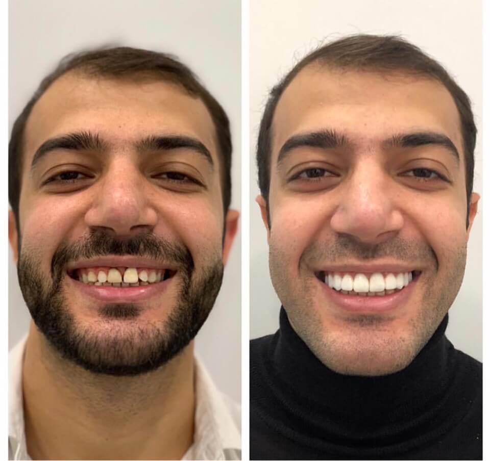 Виниры до и после фото мужчины