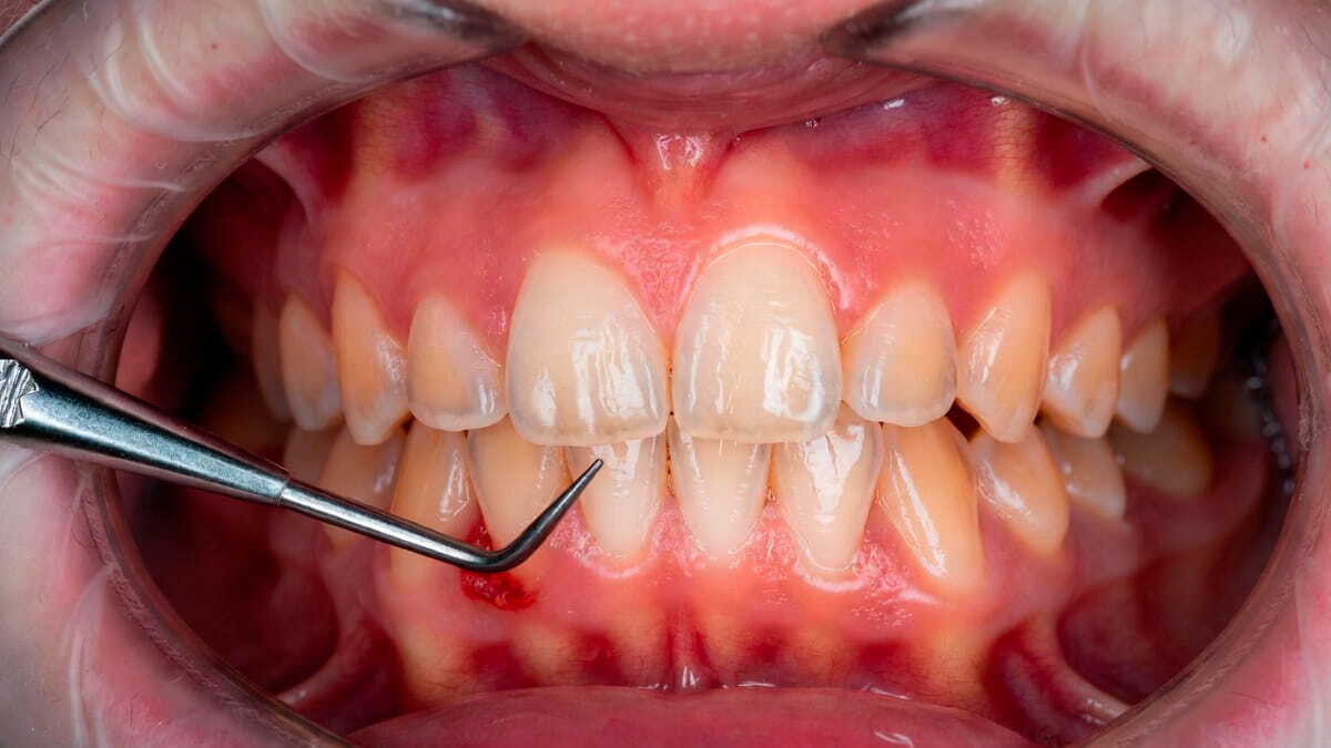 Кровоточивость и воспаление десны при ношении виниров