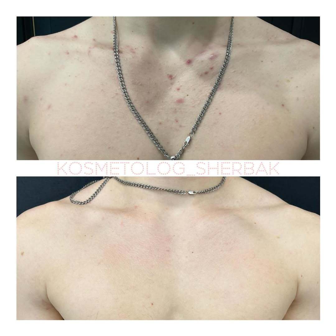 Лечение акне у женщины в клинике PradusCOSMO, СПб. До и после процедуры