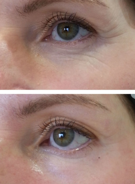 Фото 3. Эффект после препарата Meso Eye C71 до и после