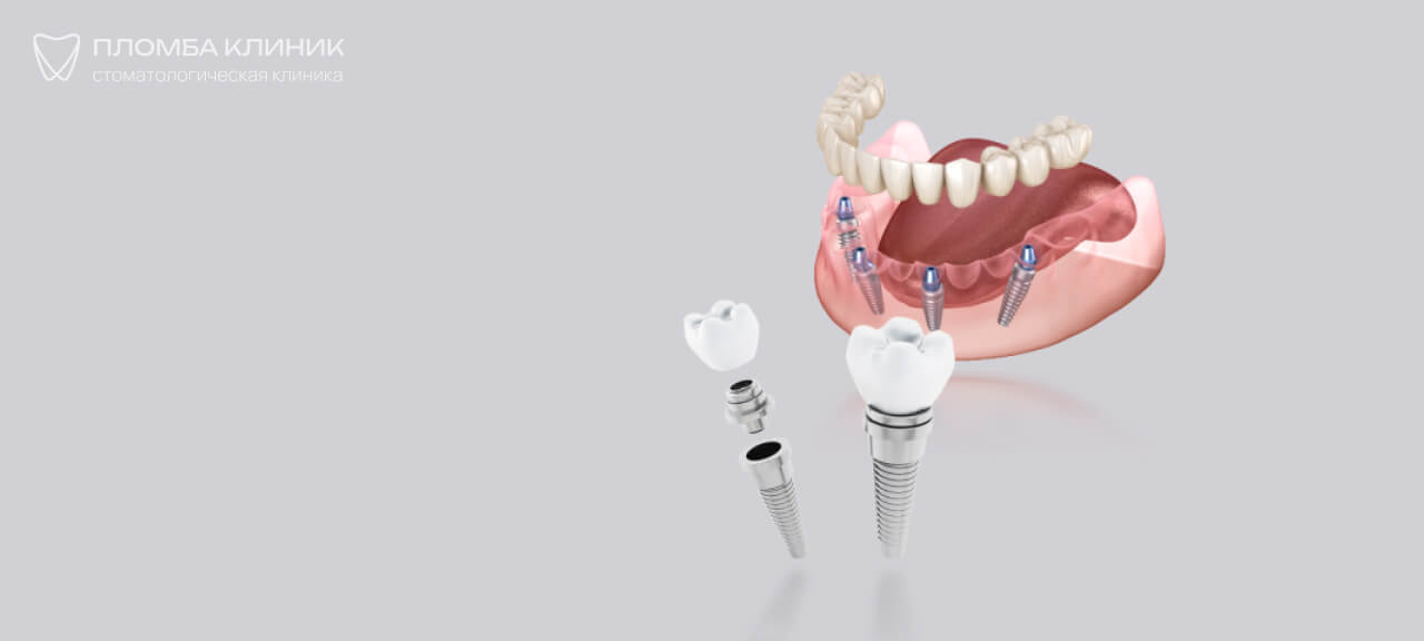 цена имплантации зубов под ключ