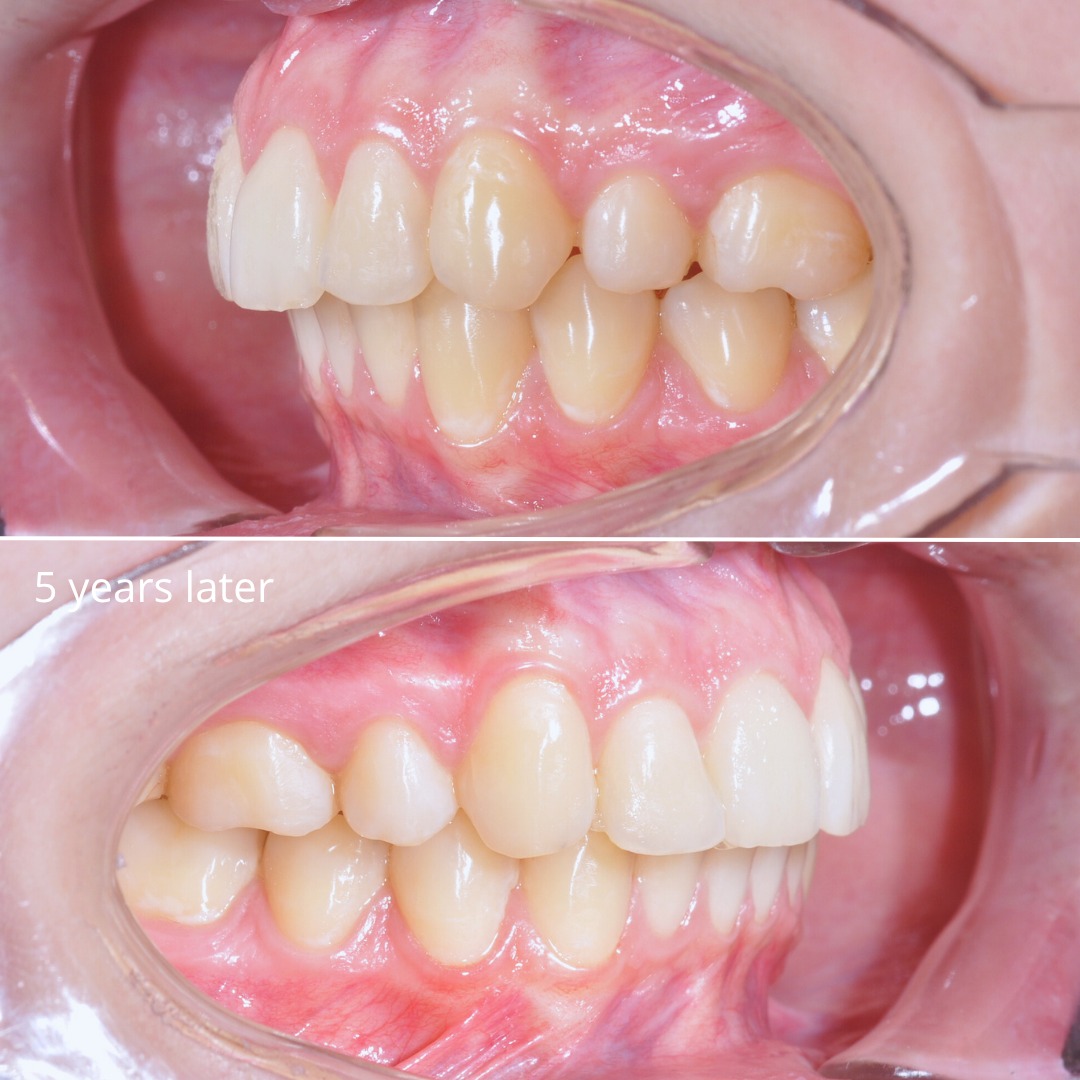After treatment and five years later: stable, balanced smile and occlusion — photo 6 of 6