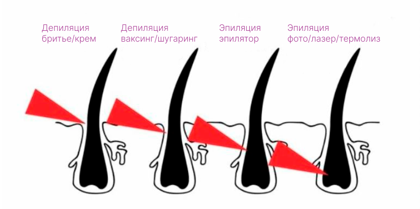 Лазерная и фотоэпиляция: в чем отличия | HappyDerm