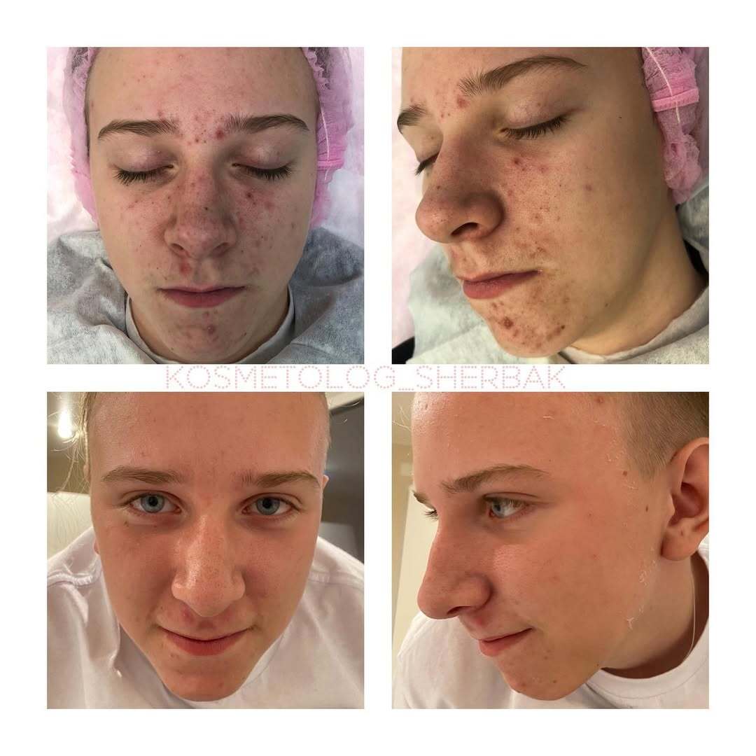 Лечение акне у женщины в клинике PradusCOSMO, СПб. До и после процедуры