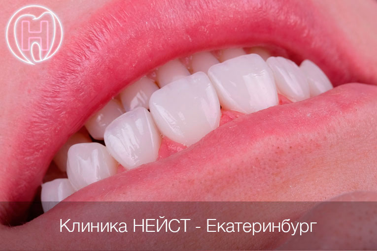 Премиальные композитные виниры в Екатеринбурге, цвет Блич 4