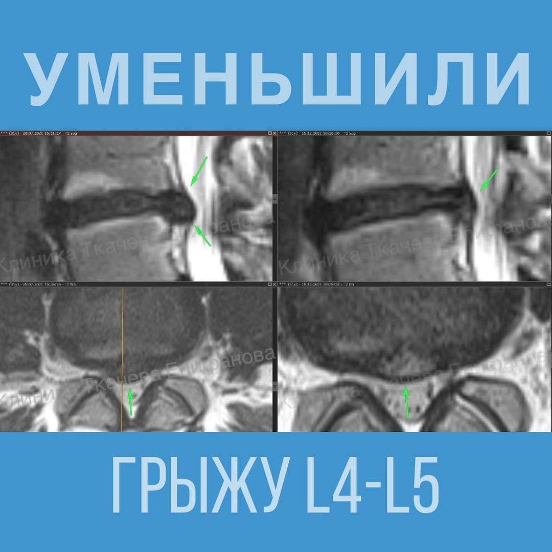 Как вылечить грыжу с ребёнком на руках 👶🏻