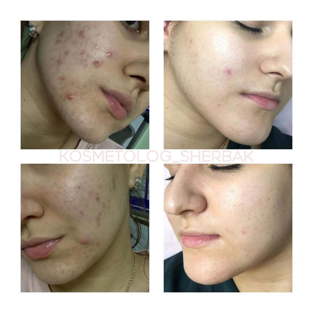 Лечение акне у женщины в клинике PradusCOSMO, СПб. До и после процедуры