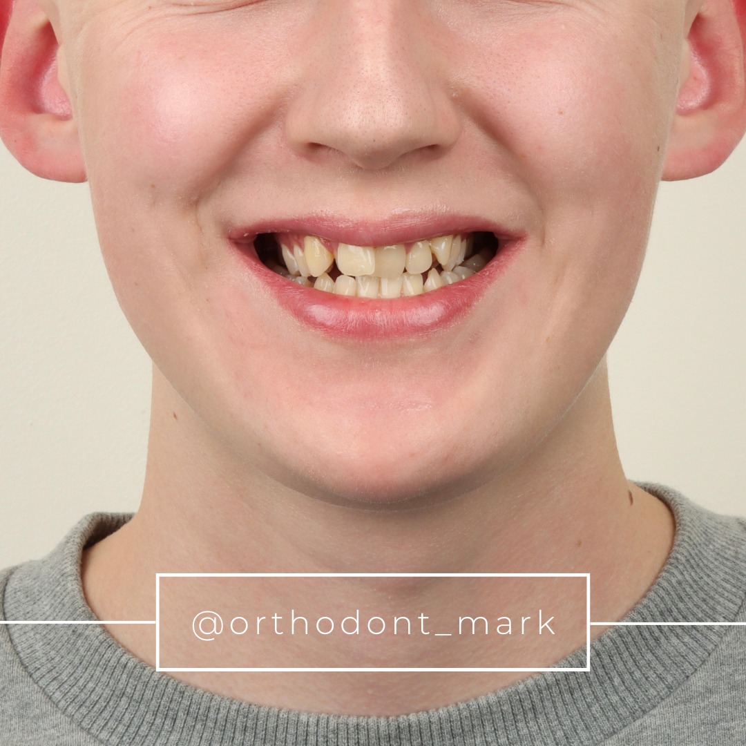 Before treatment view showing constricted maxillary arch prior to MARPE therapy in an adult patient