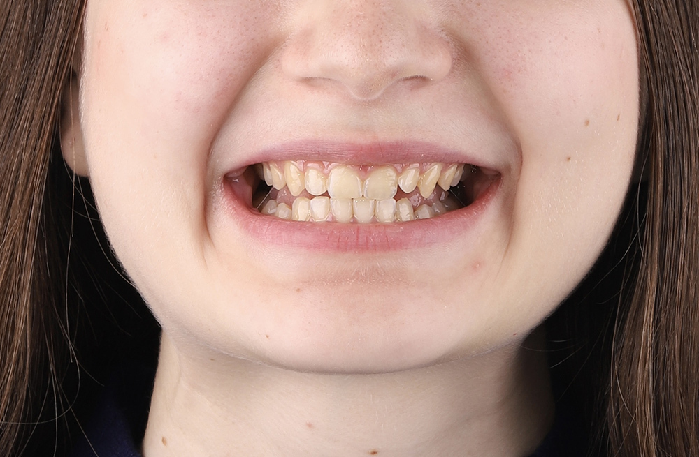 Комплексное ортодонтическое лечение глубокого прикуса и дистальной окклюзии на несъемной аппаратуре