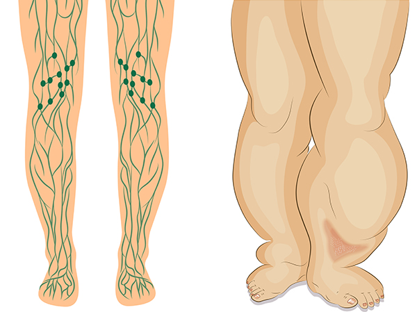 Лечение лимфостаза нижних конечностей и отеков ног
