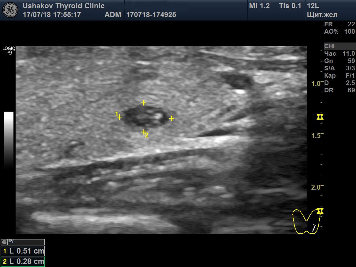 Рак щитовидки на узи. УЗИ щитовидной железы узел левой доли. УЗИ щитовидной железы микрокальцинаты.