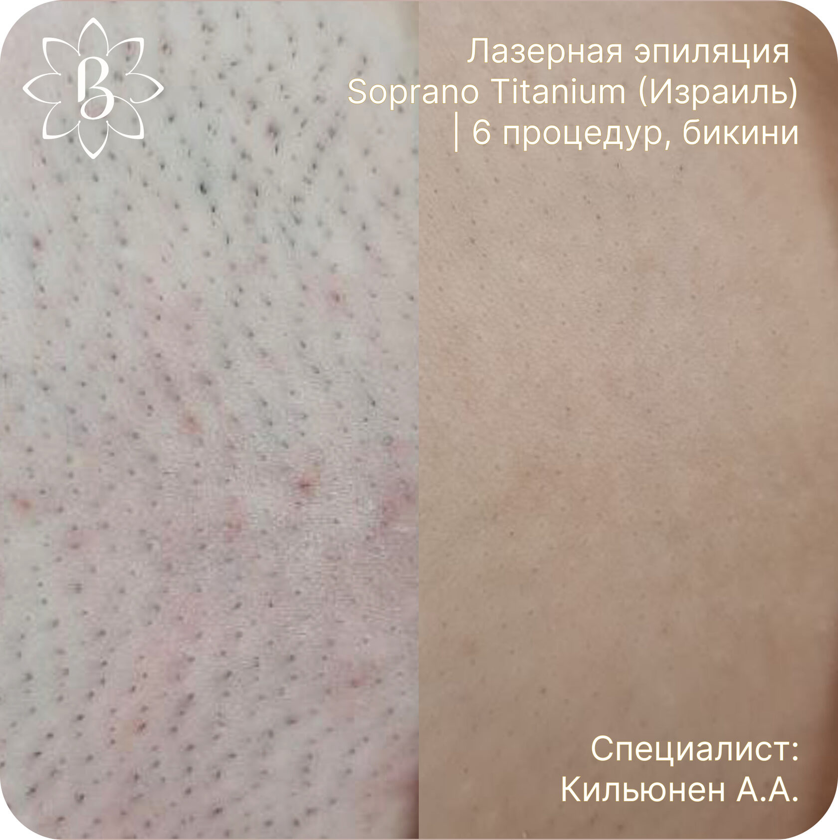 лазерная эпиляция СПб