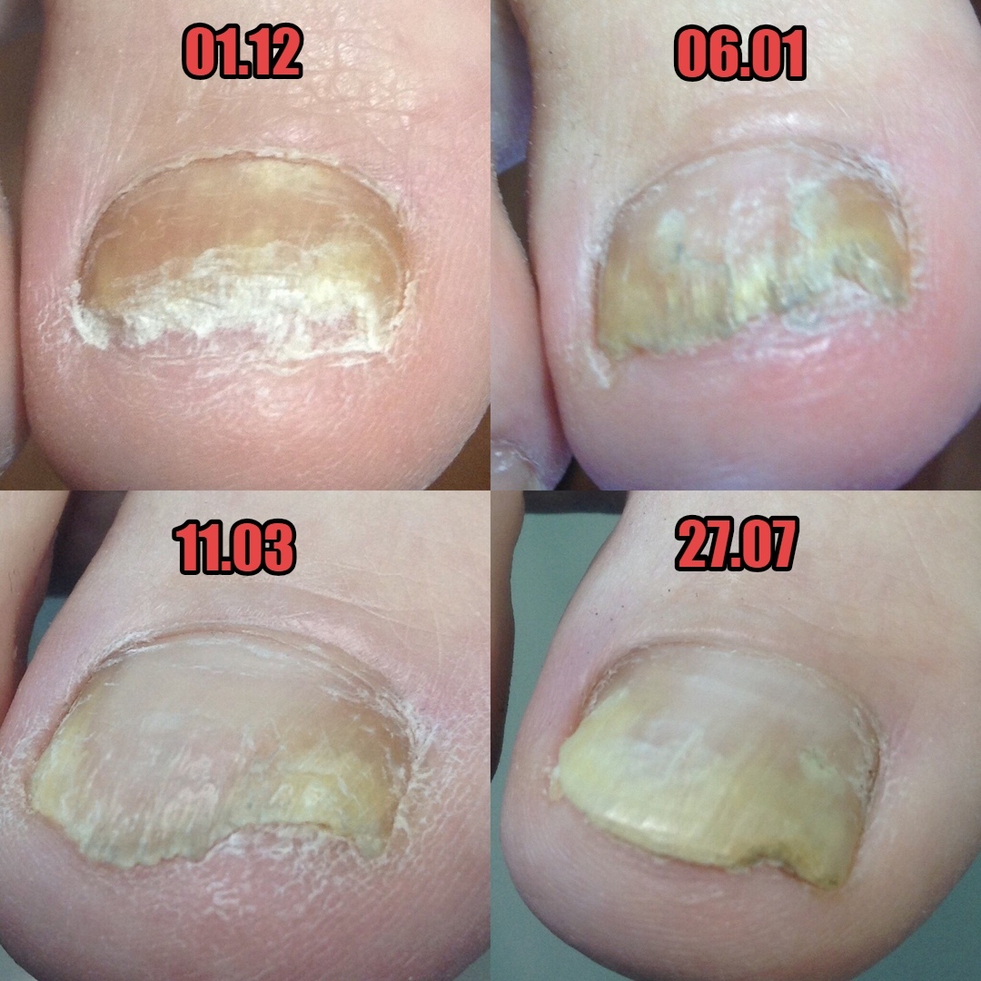 Микоз на ногах. Удаление микоза в Курске.