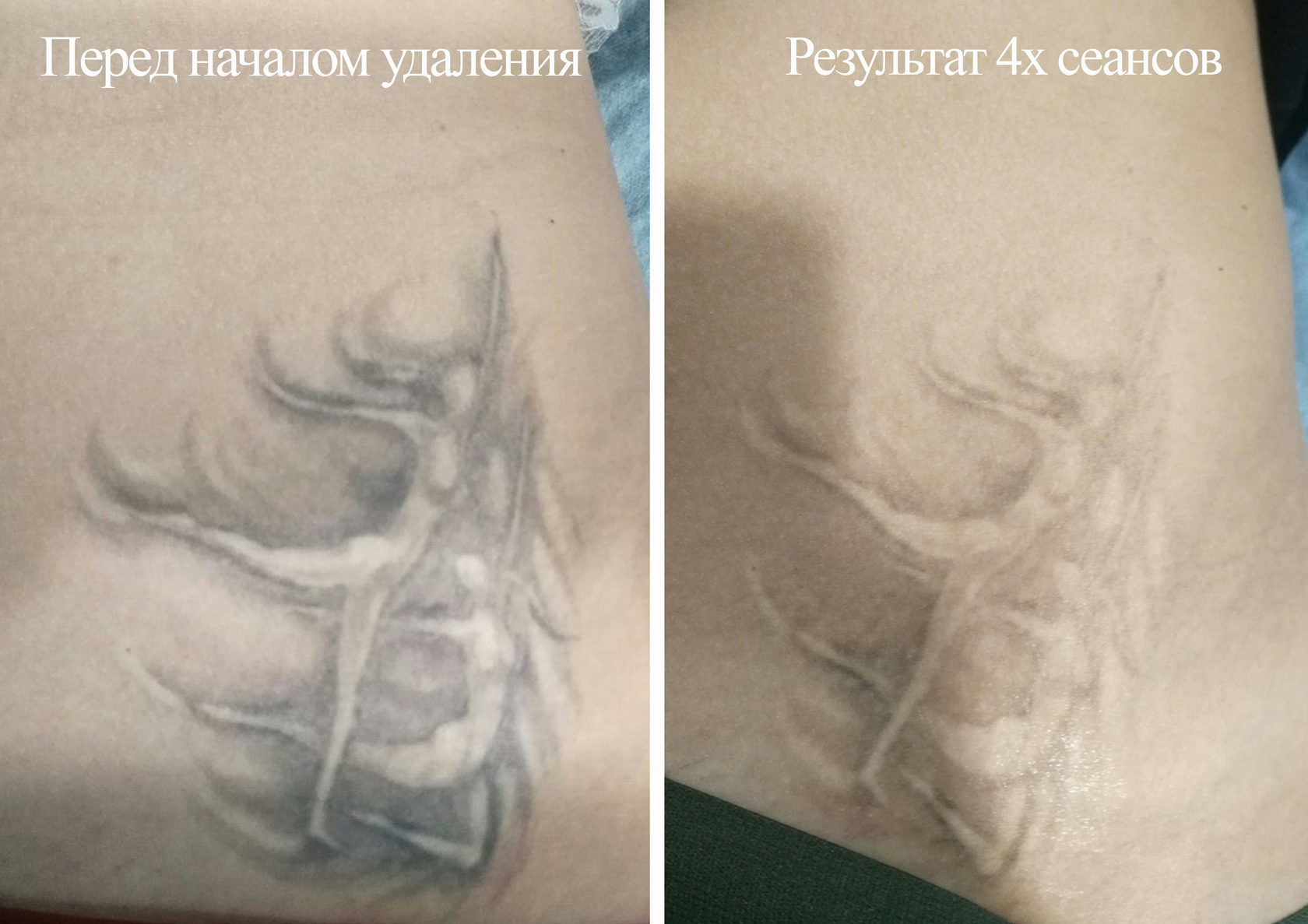 Рубцы после удаления татуировок