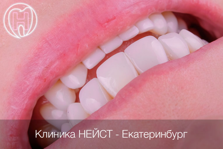 композитные виниры в Екатеринбурге, цвет Блич 3