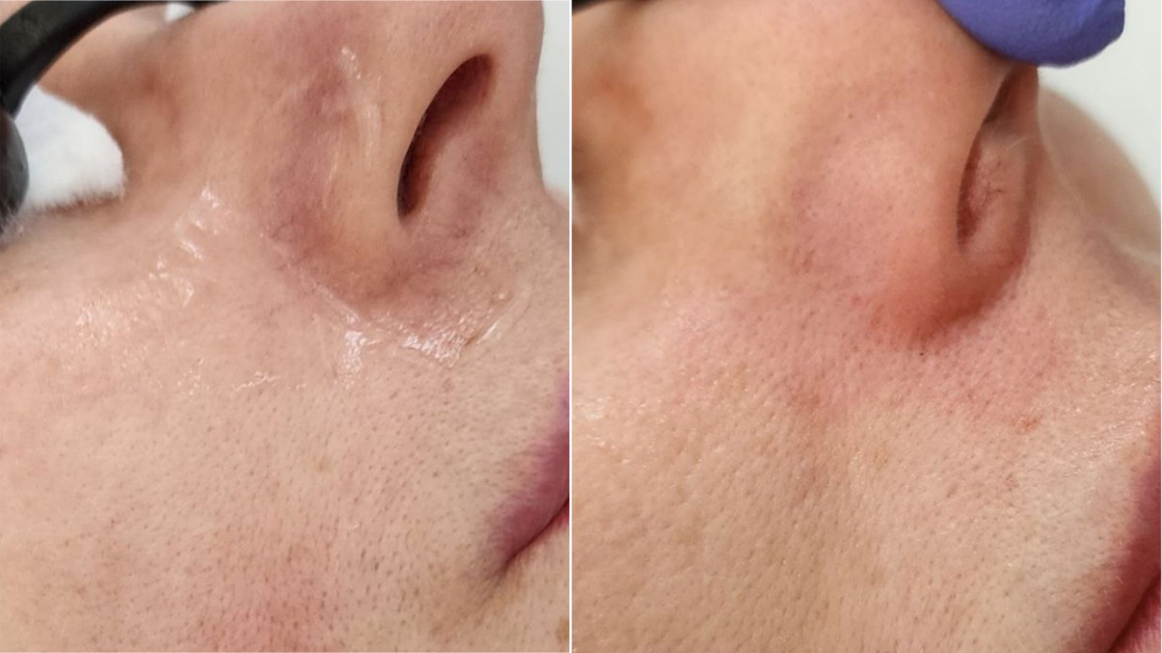 Фото до и после: удаление сосудов лазером в клинике PradusCOSMO, Санкт-Петербург. Безопасно, эффективно и без повреждений кожи