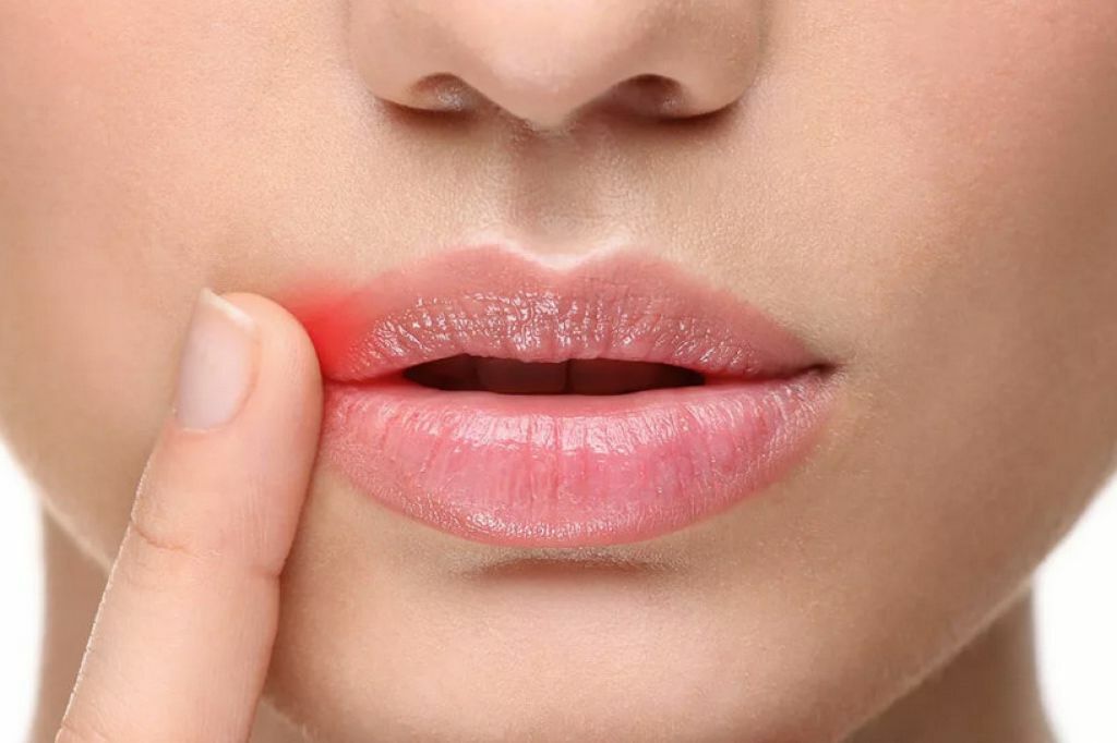 Герпес на губе | Причины, Симптомы, Лечение и Профилактика | DentalOpera