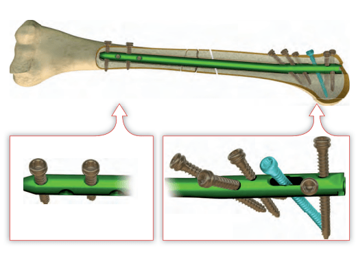 Блокируемый интрамедуллярный остеосинтез (БИОС)