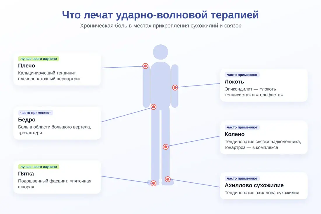 Схема показаний к ударно-волновой терапии: плечо, локоть, бедро, колено, пятка, ахиллово сухожилие