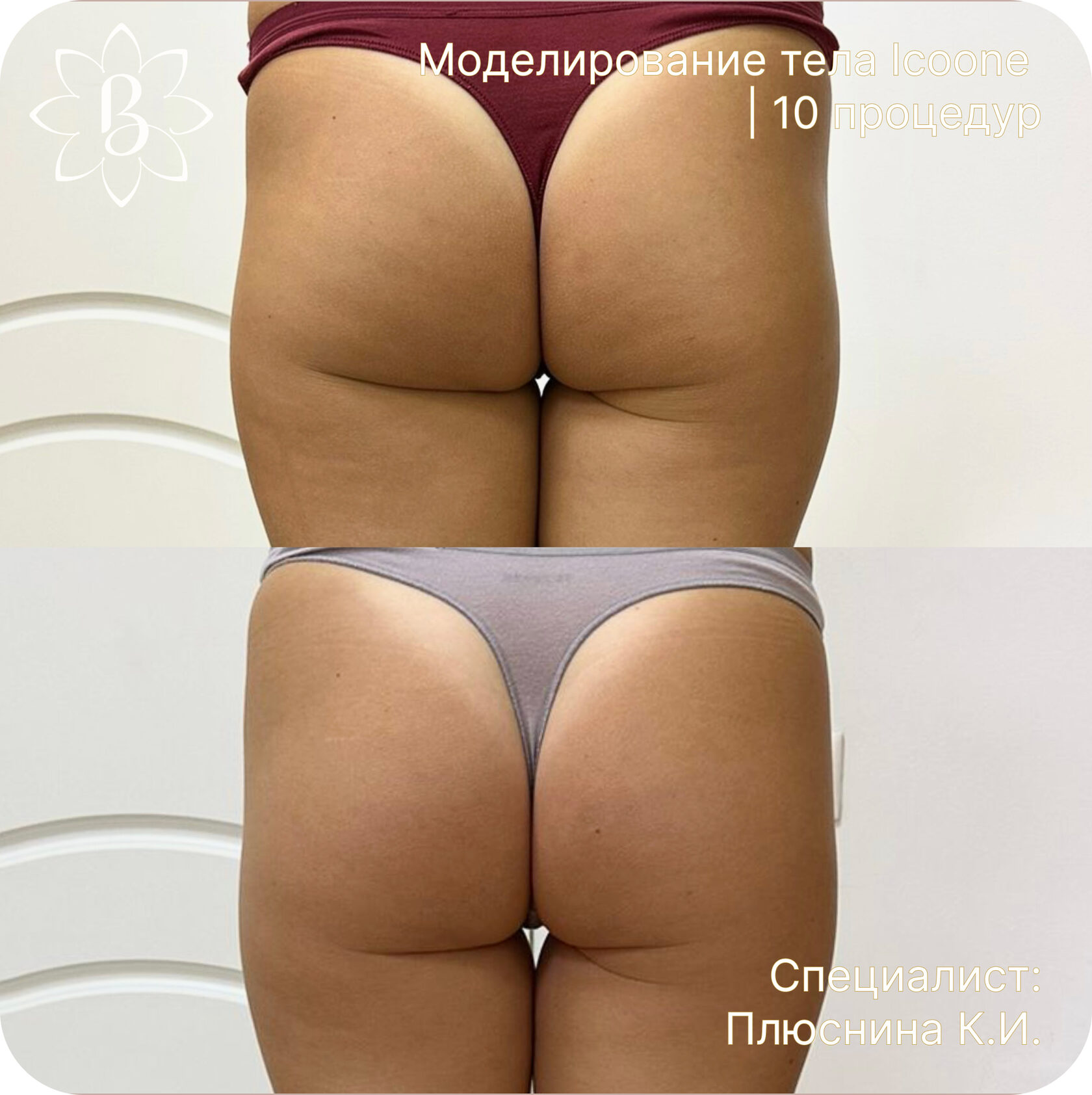 Диодная лазерная эпиляция