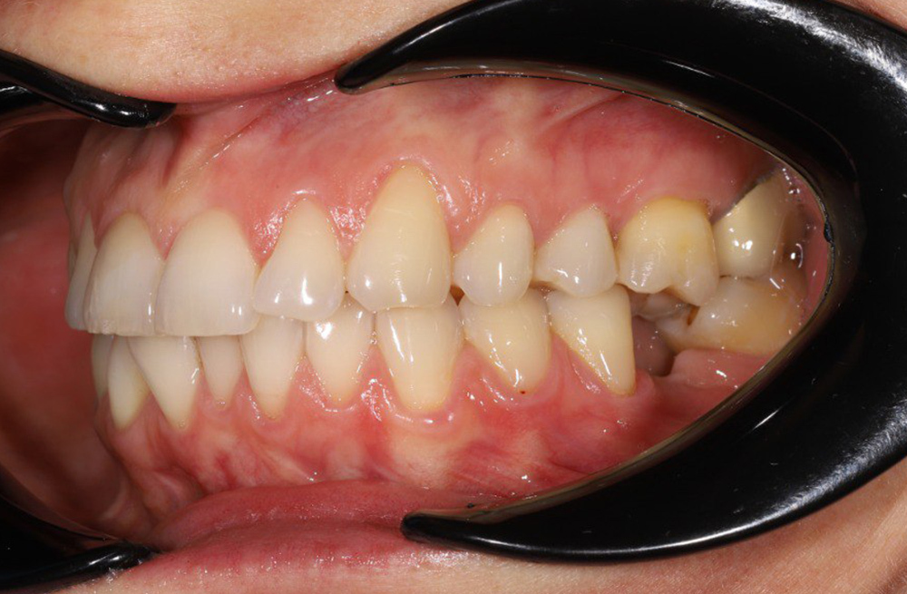 Восстановление зуба после длительного отсутствия через имплантацию и протезирование коронкой