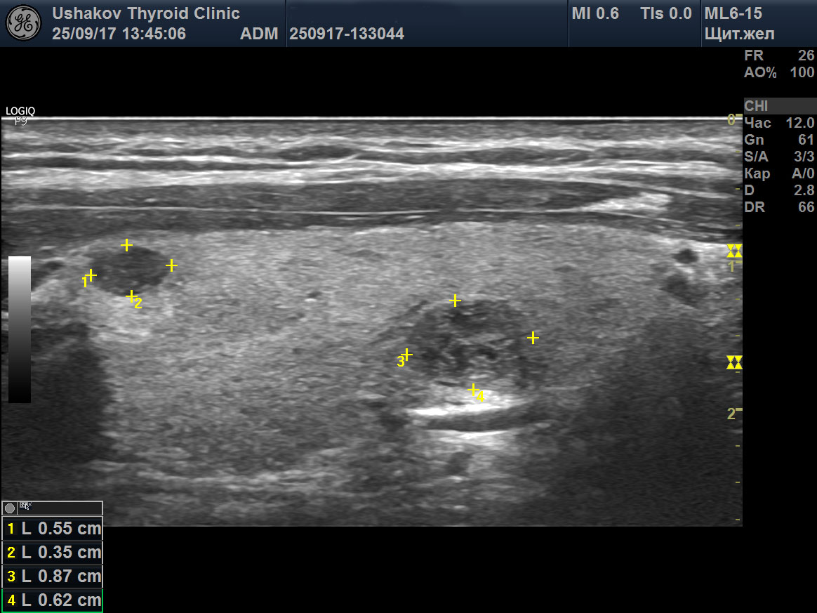 Паращитовидная железа узи картина