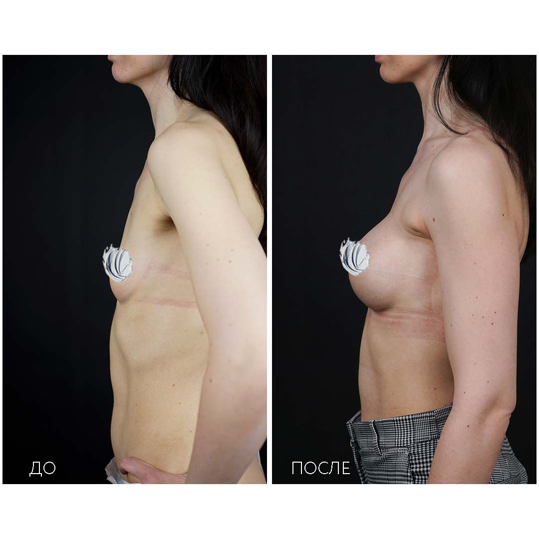 как восстановить одну грудь после кормления фото 99