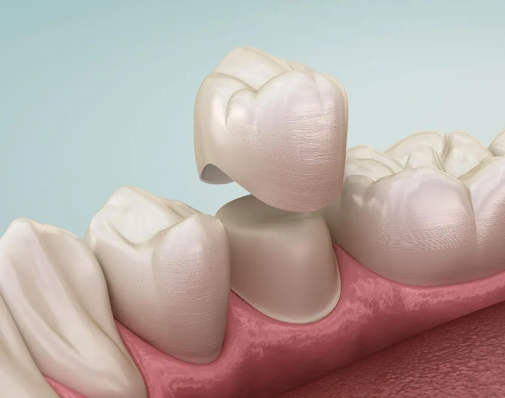 металлокерамическая и циркониевая зубная коронока