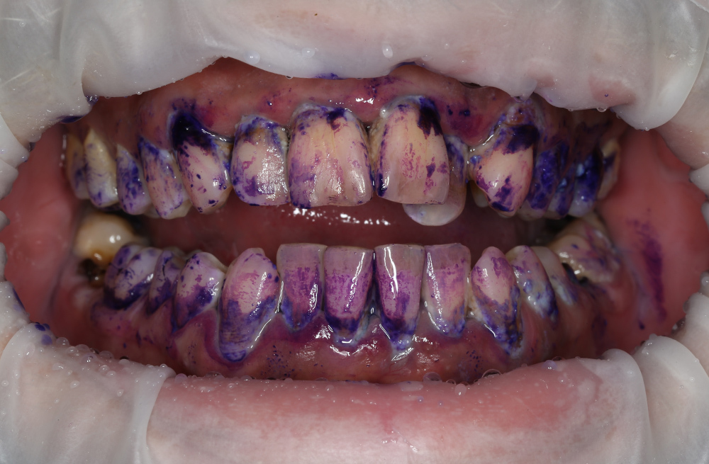 Комплексная гигиена полости рта при полном игнорировании чистки зубов