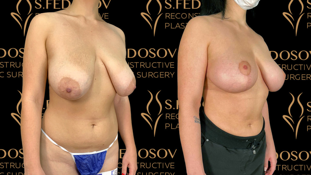 асимметрия груди у женщин форум фото 76
