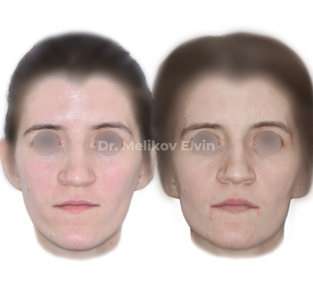 Фотографии до и после ортогнатической операции.