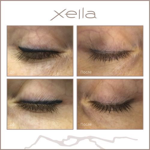 пикосекундный лазер для удаления татуажа